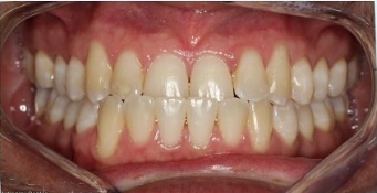 BLVD Invisalign case before photo