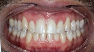 BLVD Invisalign case after photo