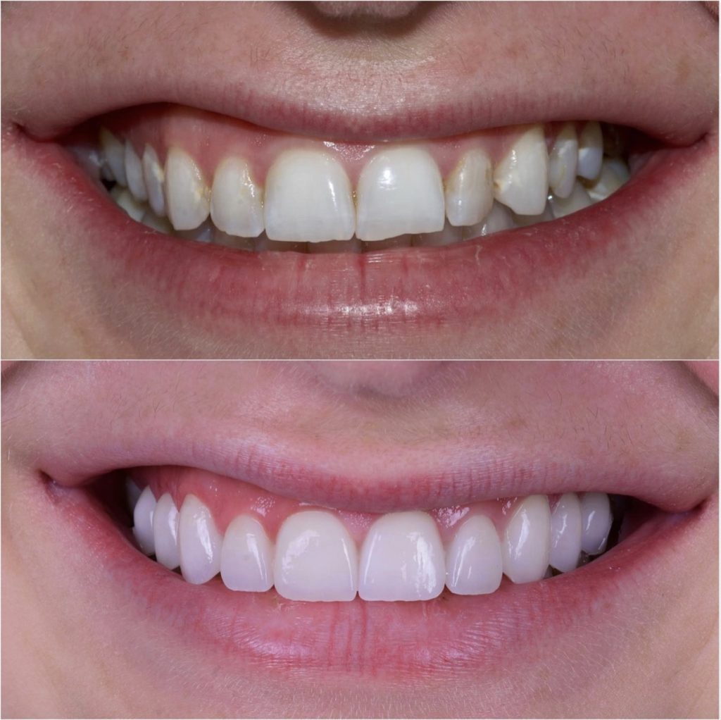 Before and after 10 porcelain veneers by Dr. Daniel Adelpour at BLVD Dental Aesthetics