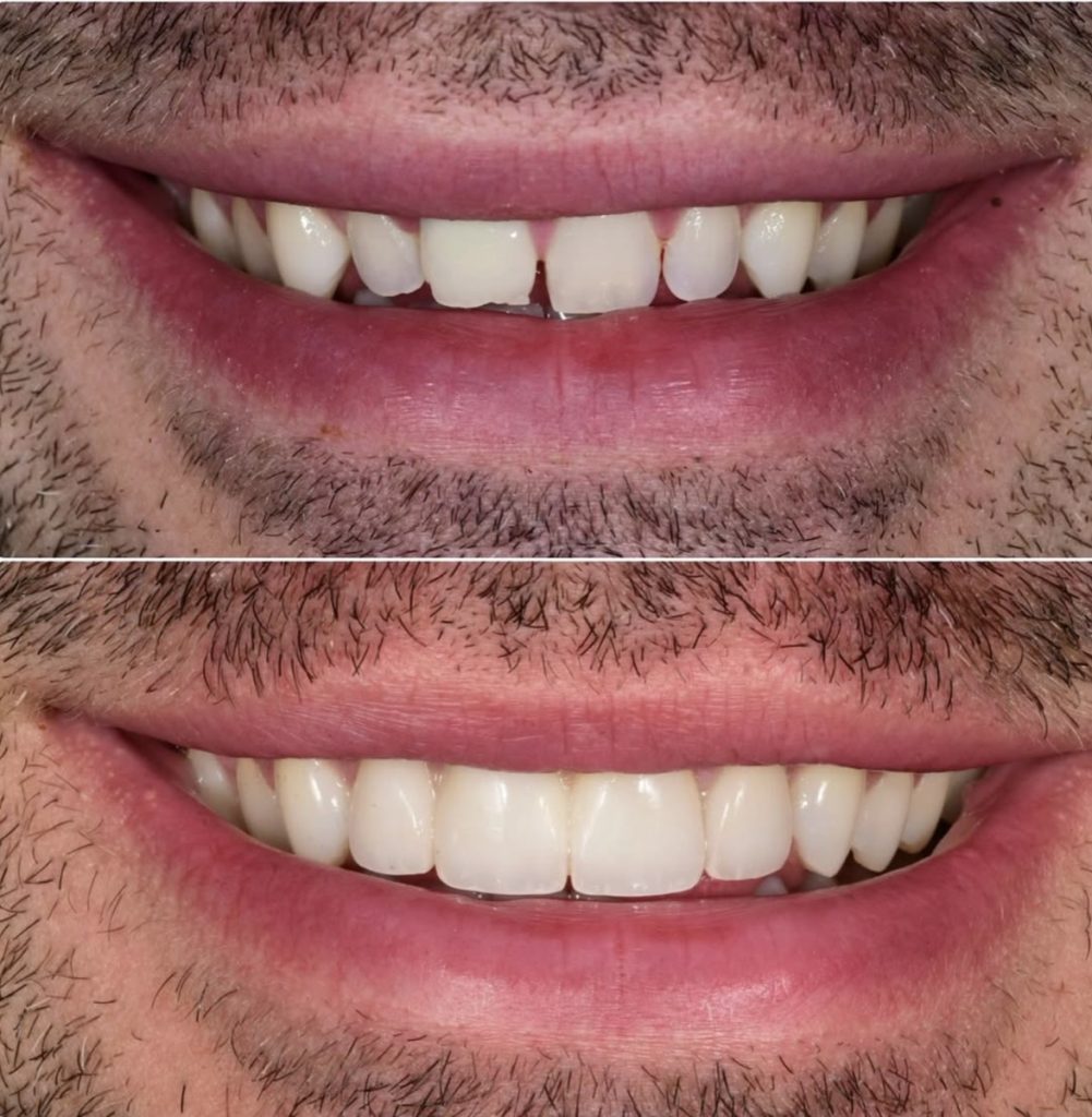 Four front veneers blended with natural teeth at BLVD Dental Aesthetics