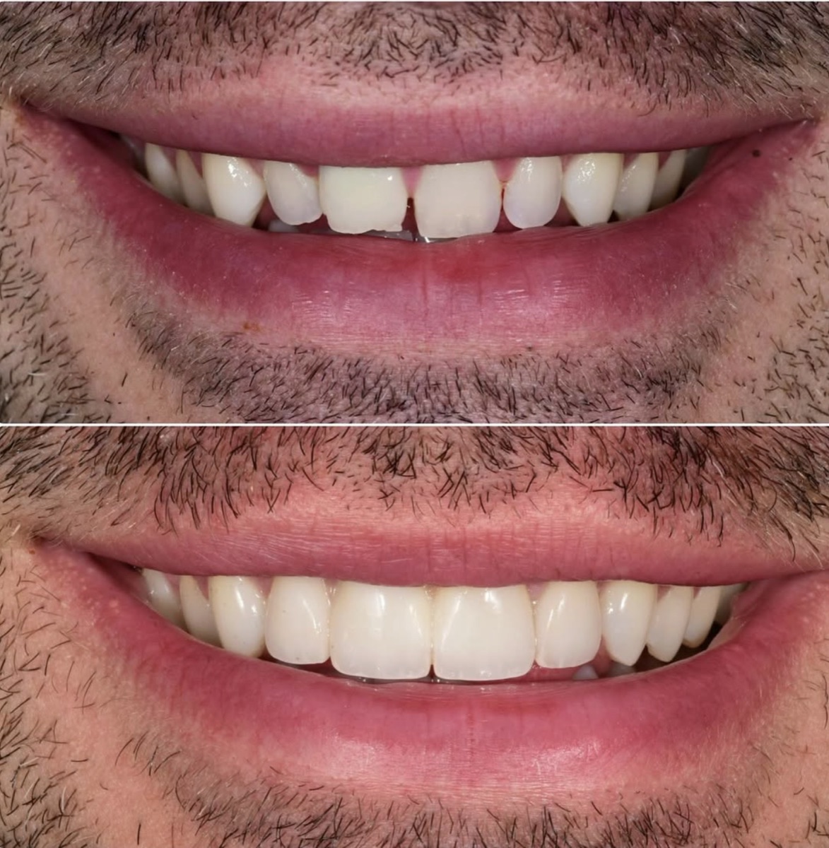 Four front veneers blended with natural teeth at BLVD Dental Aesthetics