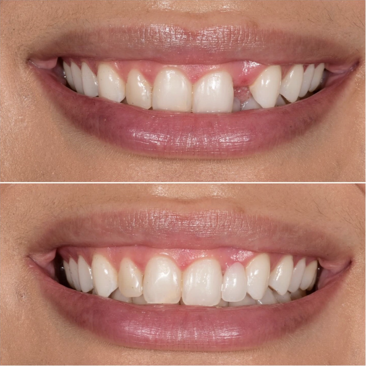 Cosmetic Maryland bridge replacing a congenitally missing front tooth at BLVD Dental Aesthetics