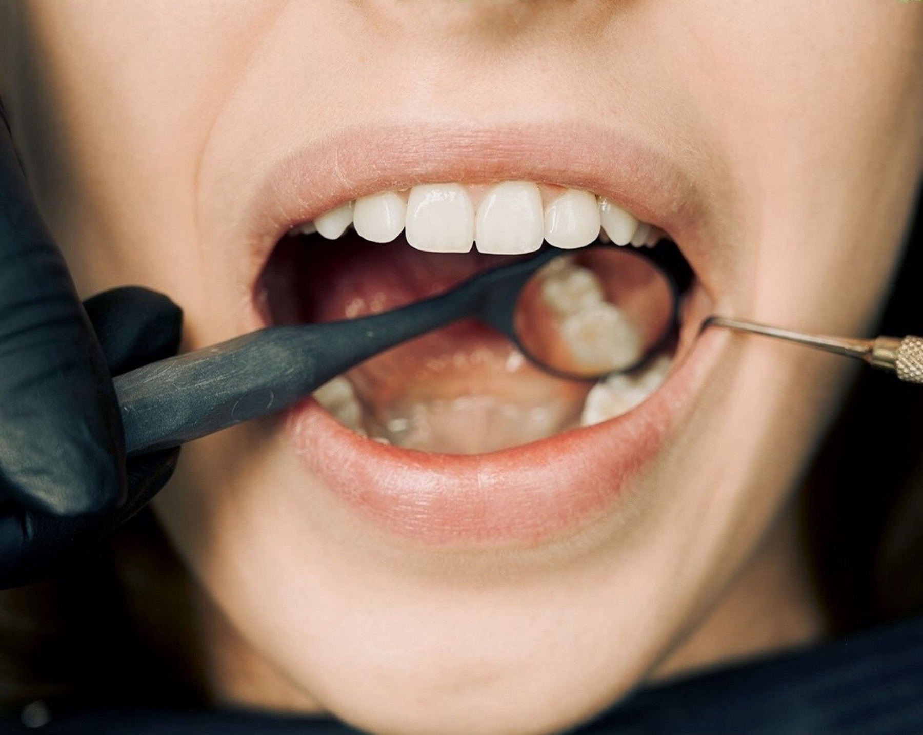 Dental examination using a mirror to evaluate a patient’s teeth and gums