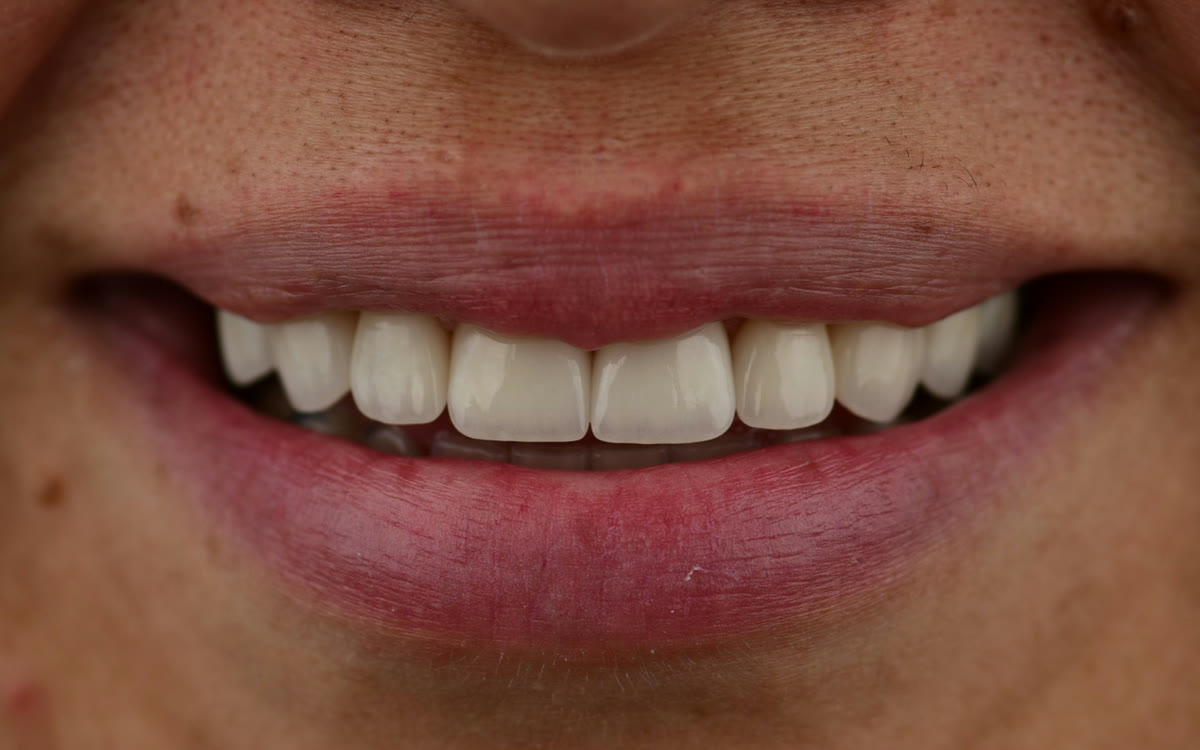After treatment with ten upper porcelain veneers at BLVD Dental Aesthetics