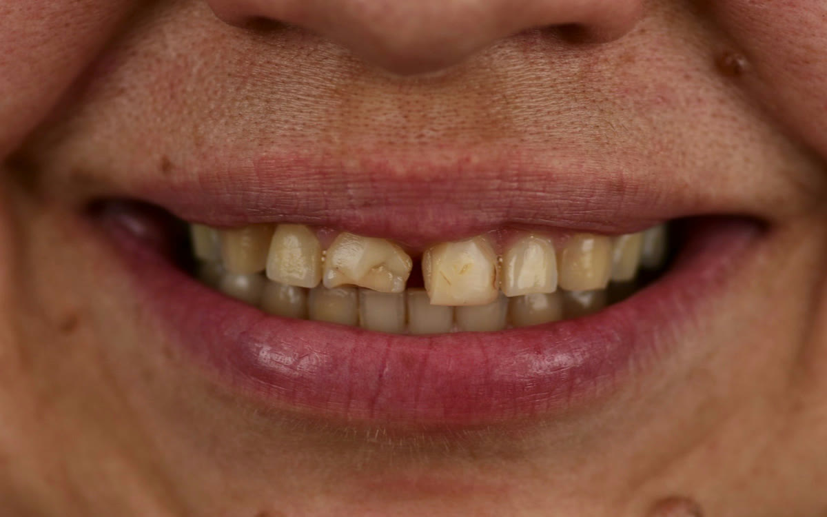 Before treatment with ten upper porcelain veneers at BLVD Dental Aesthetics