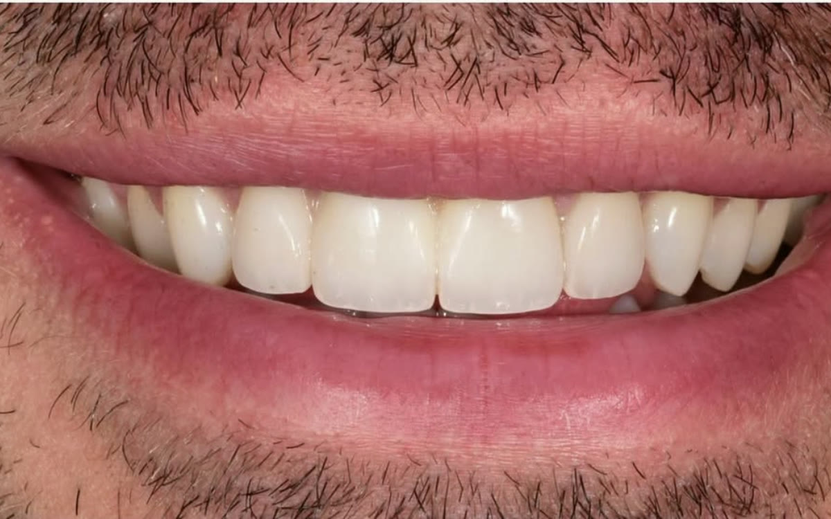 After treatment with four front porcelain veneers at BLVD Dental Aesthetics
