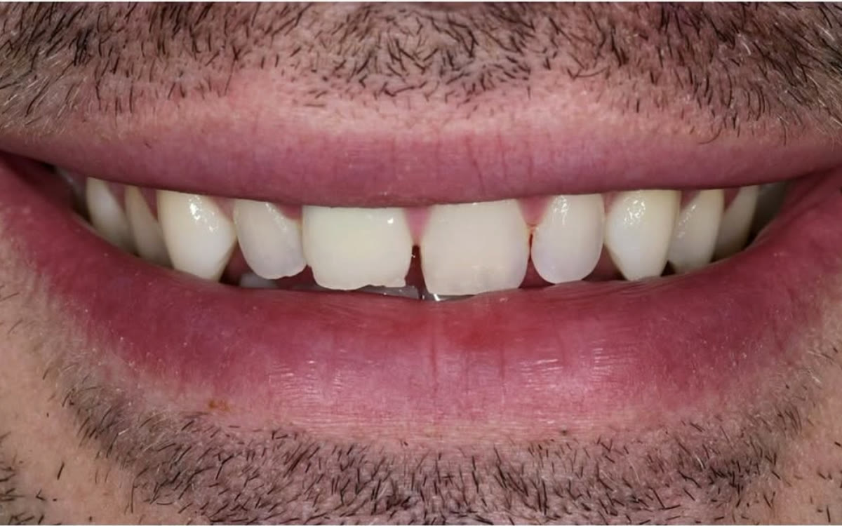 Before treatment with four front porcelain veneers at BLVD Dental Aesthetics