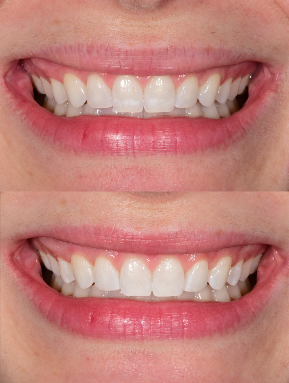 Before and immediate after ICON resin infiltration for post-braces white spots on teeth 8 and 9.