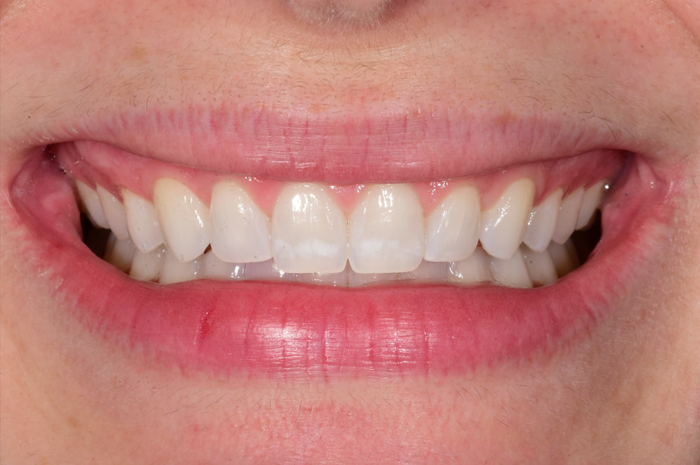 White spots after braces on teeth 8 and 9 before ICON treatment at BLVD Dental Aesthetics
