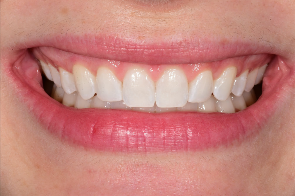 Teeth 8 and 9 immediately after ICON resin infiltration at BLVD Dental Aesthetics