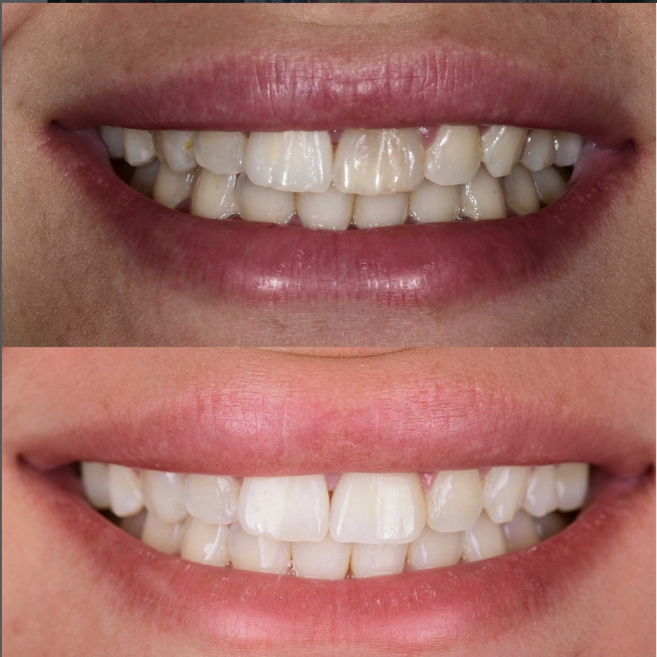 Before and after a single dark front tooth veneer at BLVD Dental Aesthetics